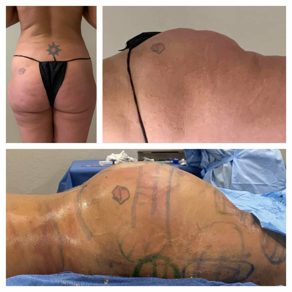 Surgery Procedures - Buttock Re-shape and Lift