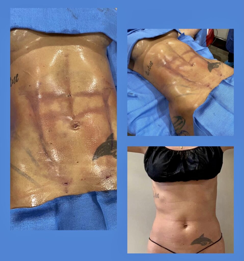 Surgical Procedure - Abdominoplasty