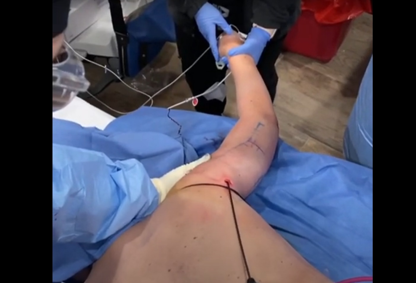 Minimally Invasive Arm Lift