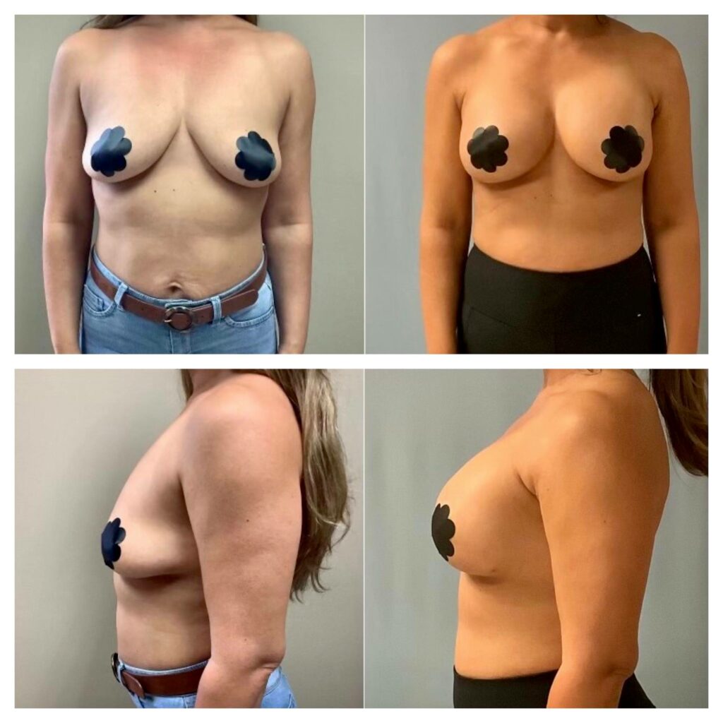 Natural Breast Augmentation