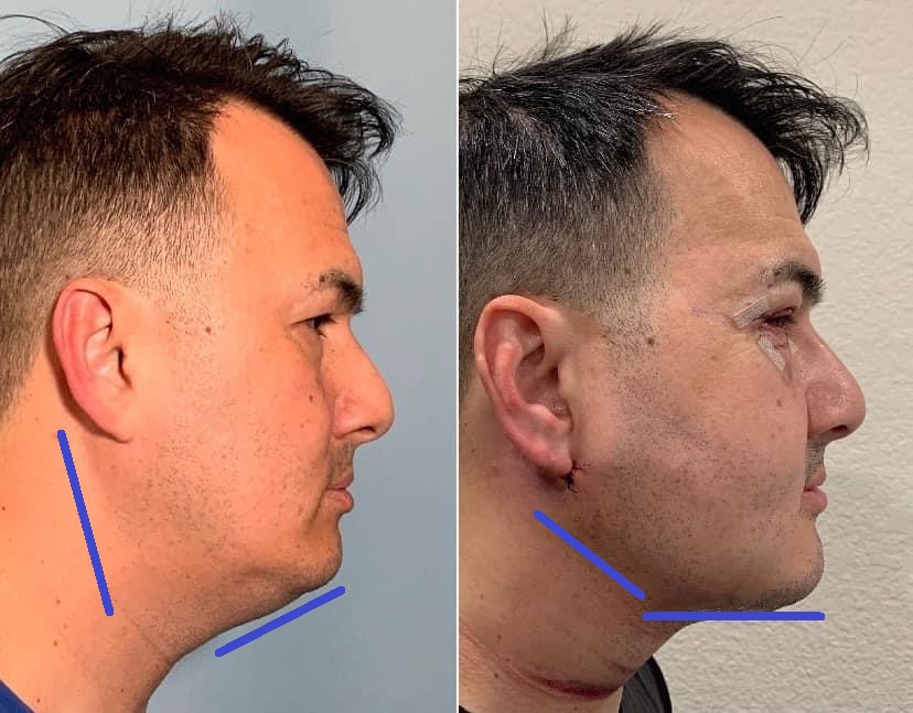 Lower Face and Neck Liposculpture