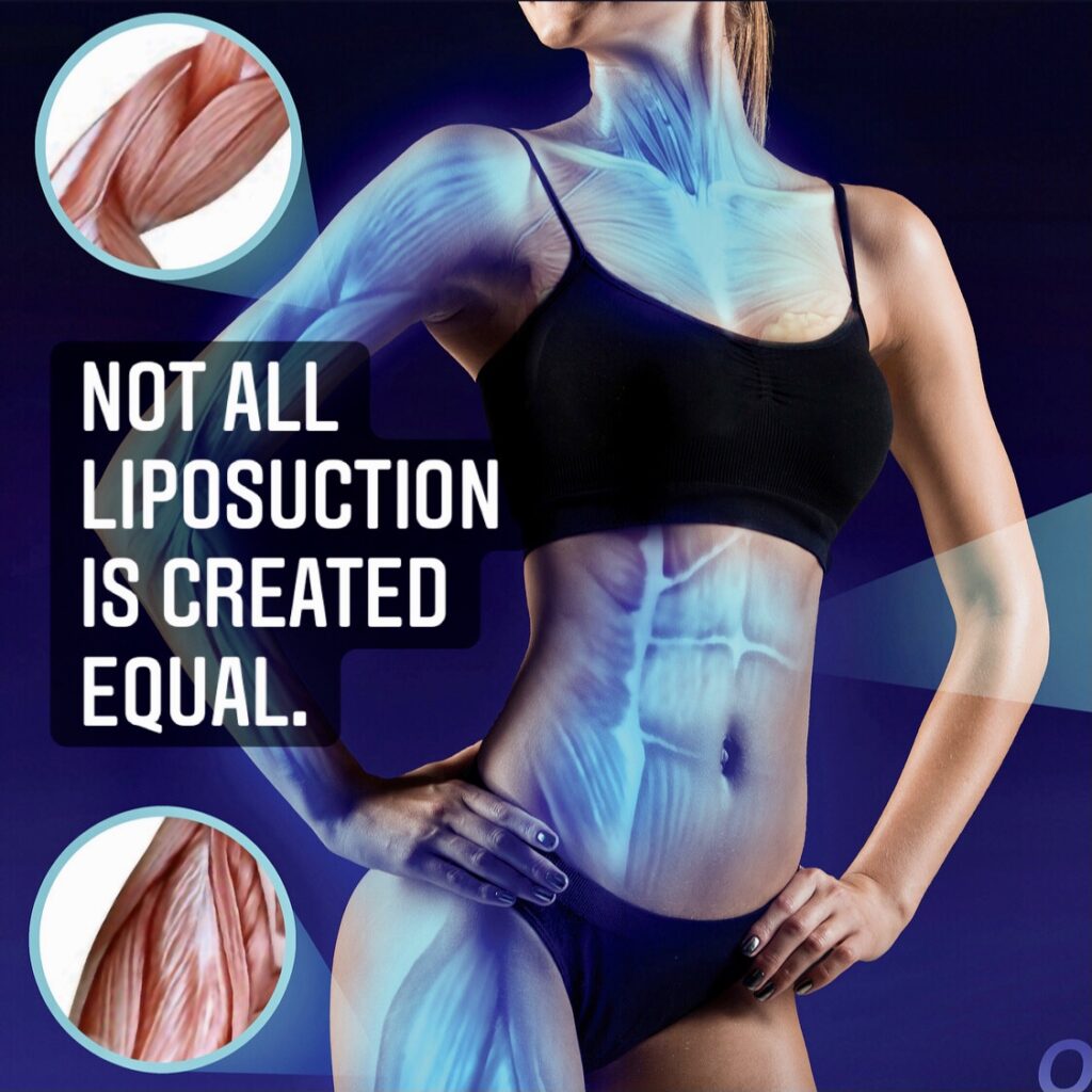 Liposuction