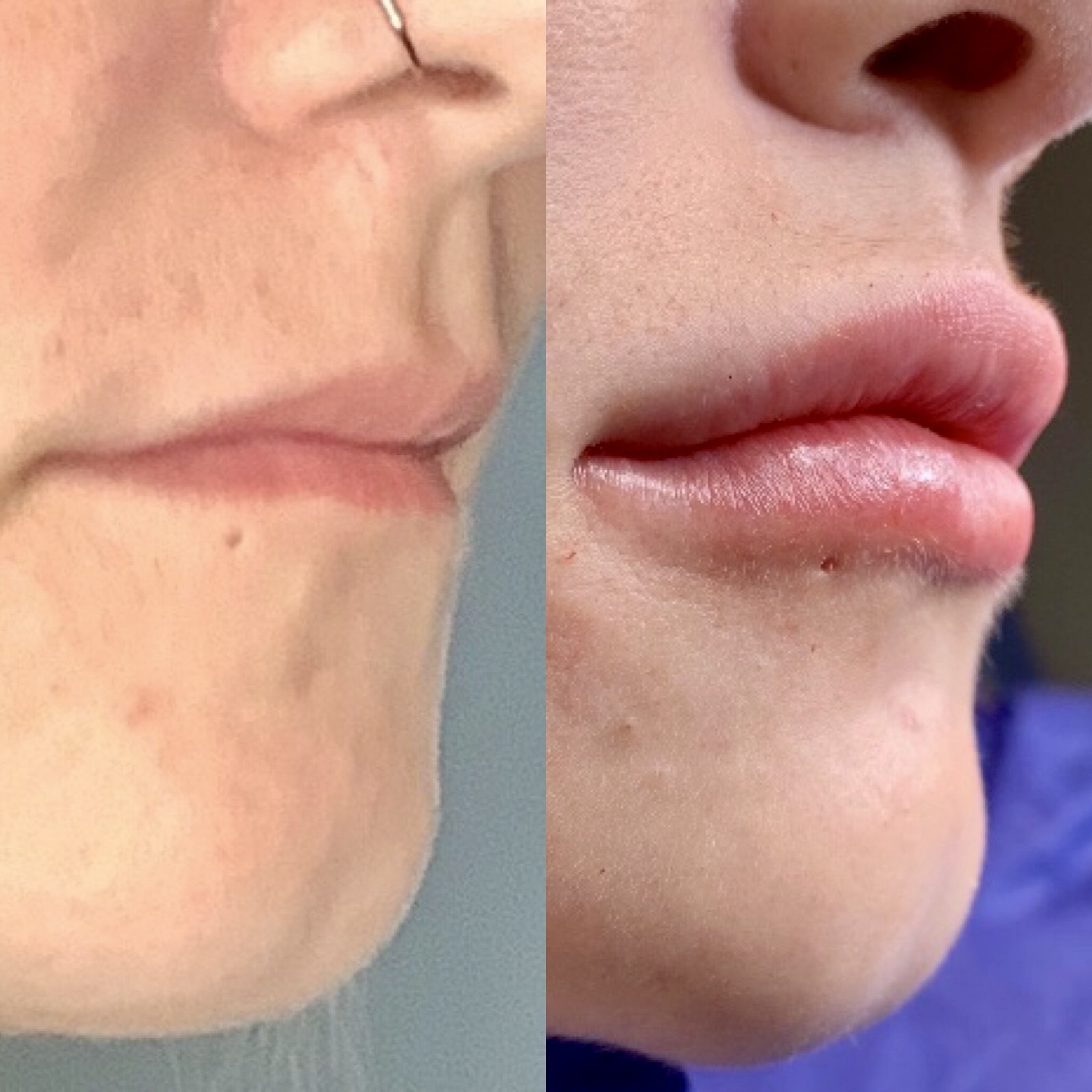 Before & After: Lips