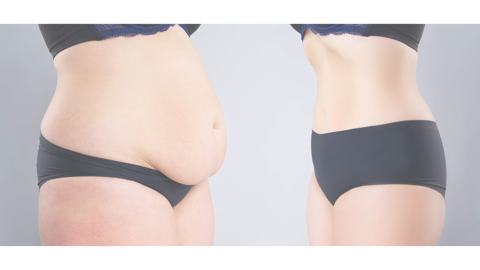 Body Contouring After Weight Loss