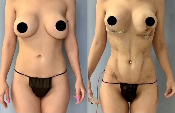 [1-Week Post-Op] Breast Lift & OrthoSculpting