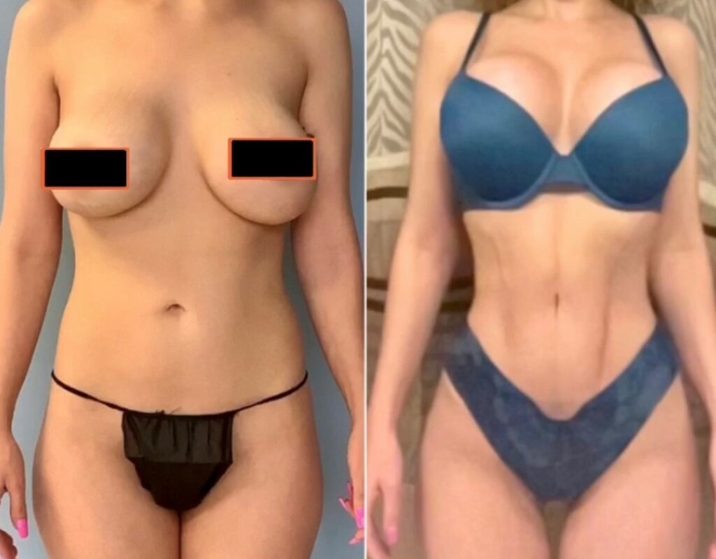 OrthoSculpt, BBL, Revision Breast Lift