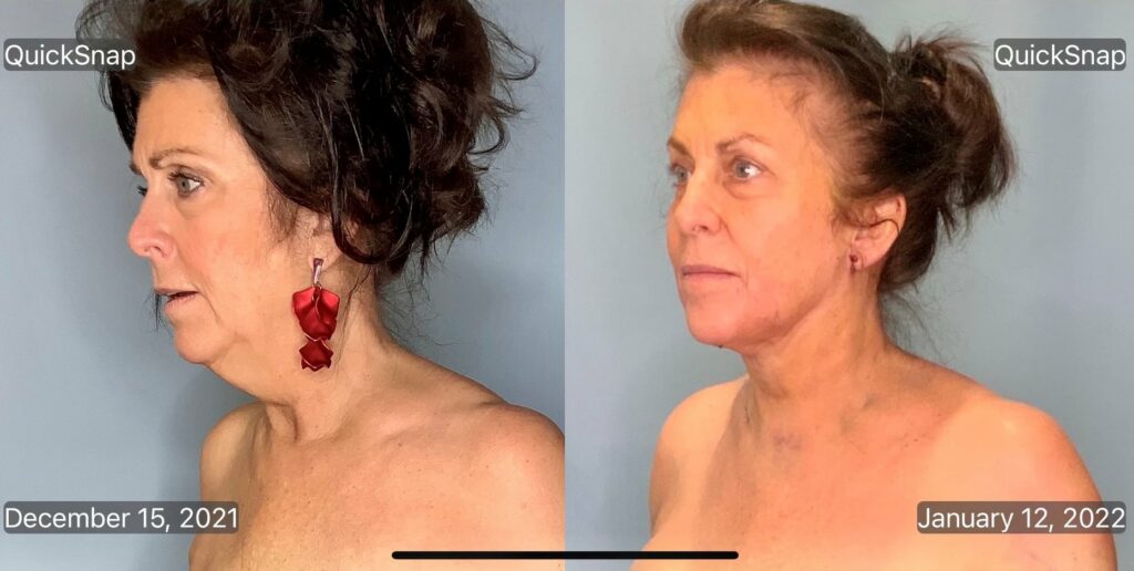 Minimally Invasive Facelift