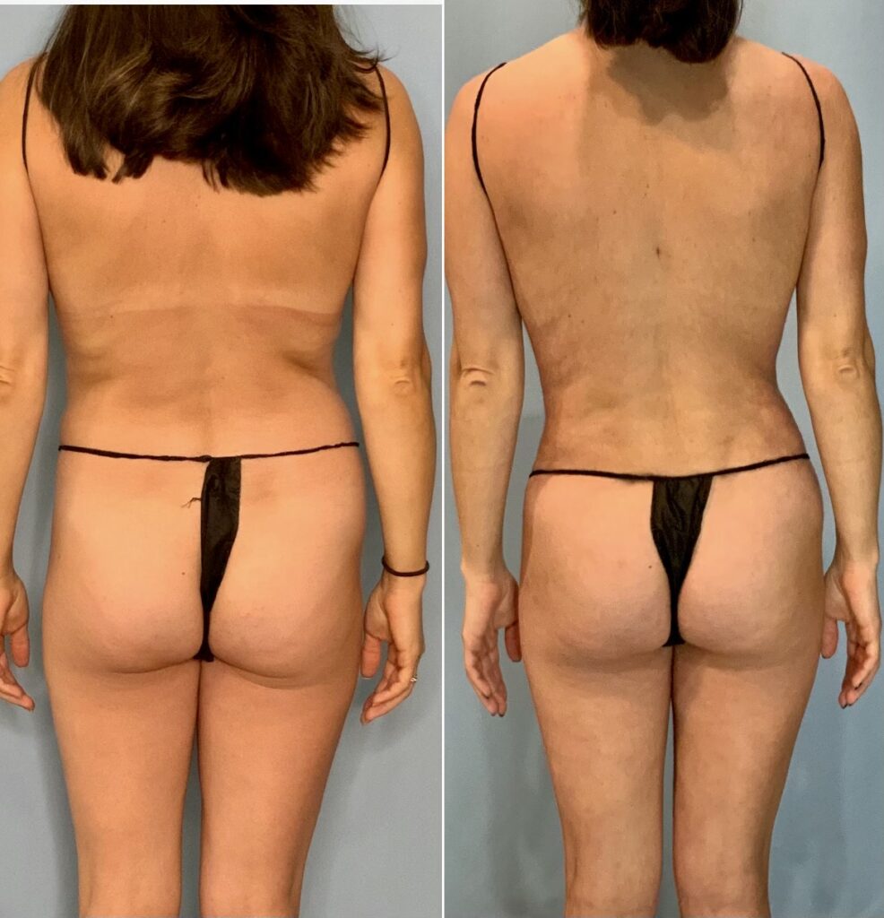 Cyr md Cosmetic Surgery - Skinny BBL