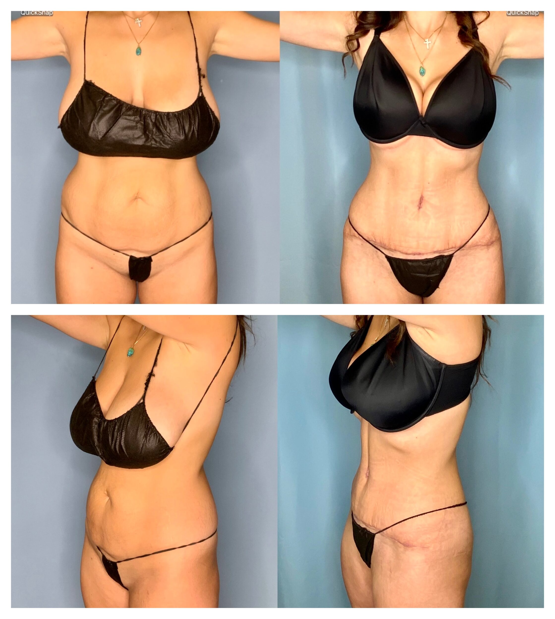 OrthoSculpt Abdominoplasty